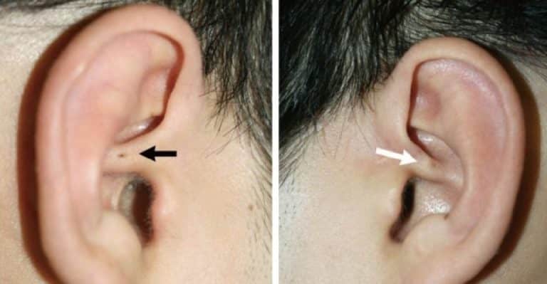 Why Some People Have a Tiny Extra Hole in Their Ear – Elite Readers