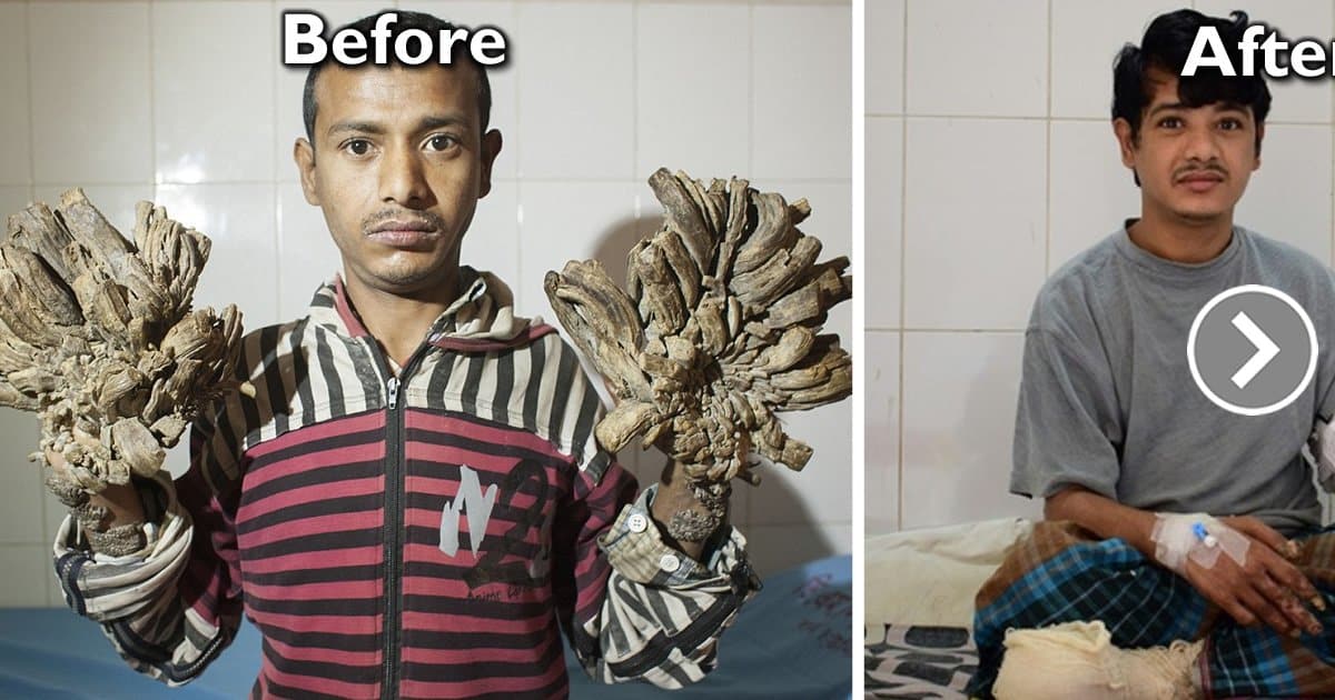 tree-man-bangladesh-featured