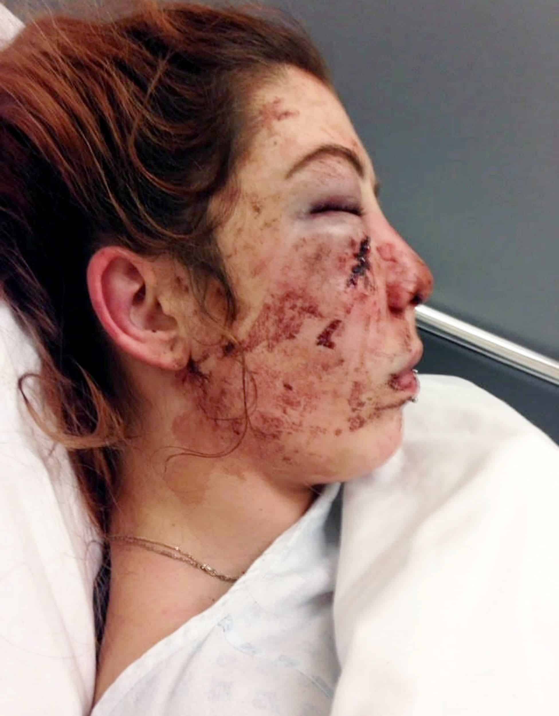 She sustained fractures on her cheeks and nose, wounds, and bruises.