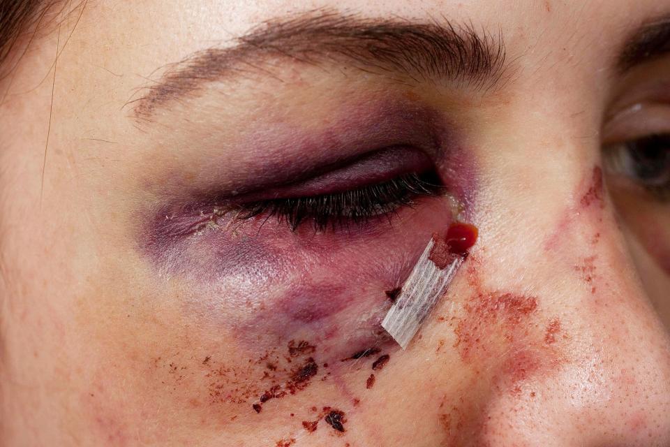 Emily had the wound under her eye stitched.